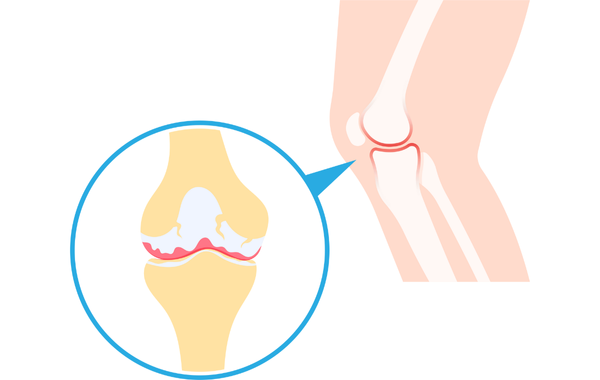 Illustration d’un genou humain vu de côté. Un zoom circulaire montre l’articulation du genou avec une usure du cartilage et des zones rouges d’inflammation, représentant une articulation arthrosique.