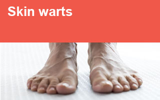 Skin warts